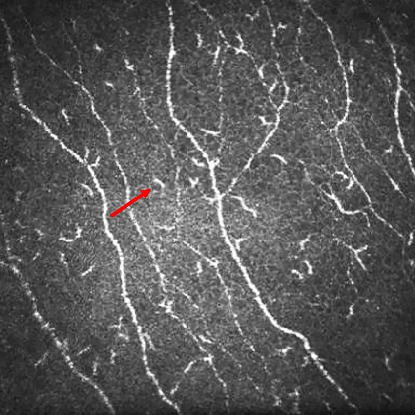 Dendritic cells in cornea