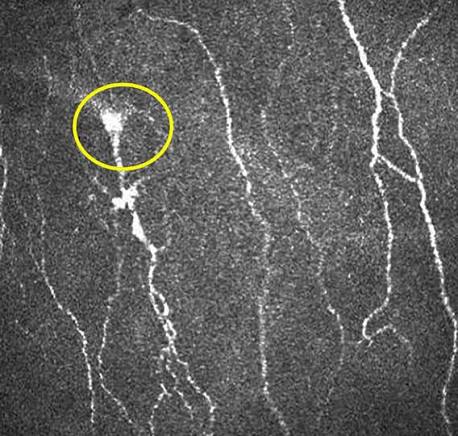 Microneuromas in cornea