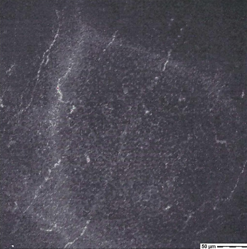 Corneal nerve loss
